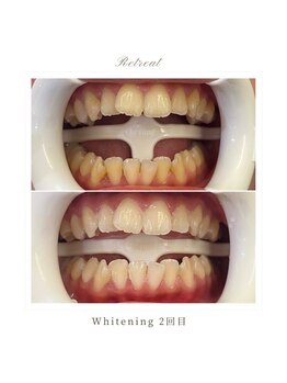 リトリート(Retreat)/ホワイトニング【2回ご来店】