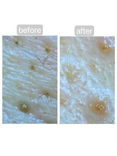 トランク(Trunk)/ハイドラ→プラズマフェイシャル