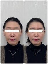 ラフテル鍼灸整骨院/乾燥するこの時期に美容鍼が◎