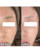 ヴィヴ コレビ(VIV COREBI)/一度でお悩み解決！