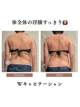 アンジェリオーラ(angeli aura)/短気痩せ！Wキャビテーション