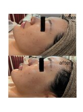 ラローゼ トウキョウ(LA ROSEE TOKYO)/【顔印象を変える輪郭デザイン】