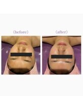 ライゼ(REISE)/ビフォーアフターご紹介(毛穴)