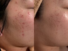 カレンジェビューティー(CarengeBeauty)/プラチナクレイピール