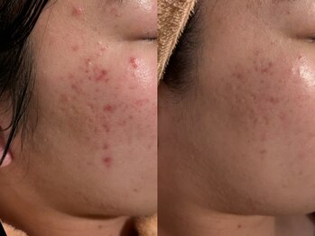 カレンジェビューティー(CarengeBeauty)/プラチナクレイピール