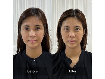 アネラ 南森町(ANERA)/小顔矯正&毛穴洗浄before after