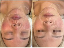 アンベリール(Embellir)/REVIピーリング/1回目→5回目