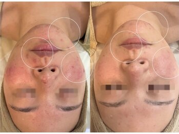 アンベリール(Embellir)/REVIピーリング/1回目→5回目