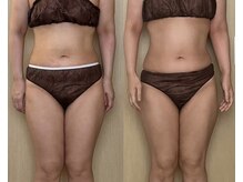 モモリラ(momorila)/活性リンパ洗浄