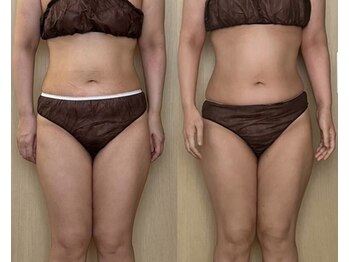 モモリラ(momorila)/活性リンパ洗浄