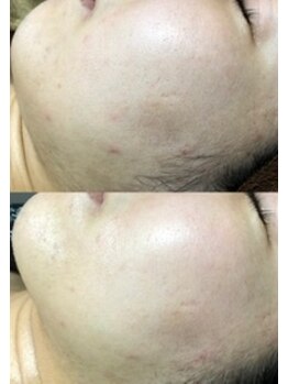 エンジェルワックス 蒲田店(Angel Wax)/【カーボキシー】