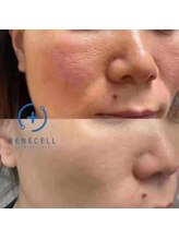 ステップイン(Step in)/ダイヤモンドピールプログラム