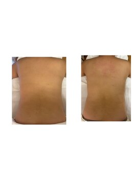 マイマイ(maimai)/背中ビフォー、アフター