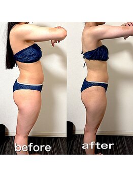 エステサロンクオーツ/１ヶ月での変化♪