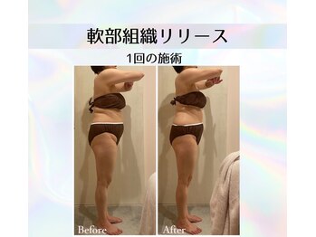 ナナイロ(nanairo)/痛みが少ない痩身 軟部組織