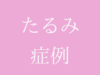 ビープラス(BEE PLUS)/美容鍼でのたるみケア