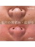 【次世代ピーリング×毛穴悩み】バリアサポート・透明感）毛穴つるん肌コース