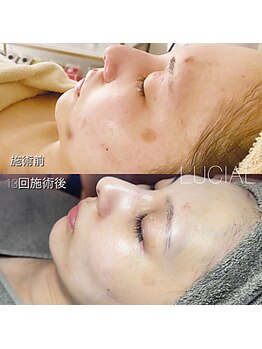 ルシアル 南浦和店(LUCIAL)/ルシアルメソッドシミケア