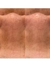 クラルテ(CLARTE)/1回の効果☆