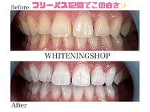 ホワイトニングショップ 名古屋店/【ビフォーアフター】フリーパス