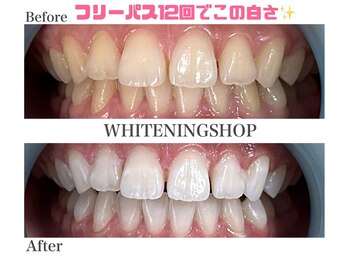 ホワイトニングショップ 名古屋店/【ビフォーアフター】フリーパス