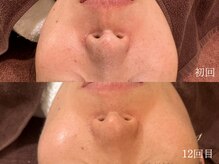 ウォーム(warm)/毛穴/毛穴洗浄/毛穴ケア/毛穴