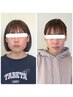 【顔が四角くなってきた方】エラ張り改善小顔矯正￥11000⇒￥7700