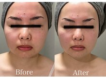 エレーナ(ELENA)/BBL光フェイシャル