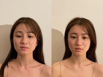 ボディラボ(BODYLABO)/小顔筋膜矯正のビフォーアフター