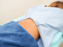 すかい鍼灸整体院/鍼（ボディ）