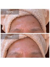 シュガー(Sugar...iyr)/【REVI】陶肌ハーブピーリング