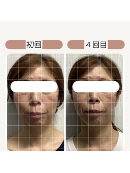 サロン ド ハリッシュ(Salon de HARISH)/お鼻の位置も高く◎