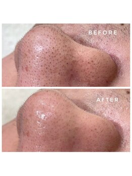 ガレリア エステ 名駅(GALLARIA)/毛穴スッキリ