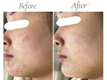 ミラリー(MIRALY)/ほほ顎ニキビケア 6ヶ月(20代)