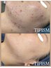 【ダウンタイムなし★】ニキビ・肌荒れ特化♪水光肌TIPハーブピーリング