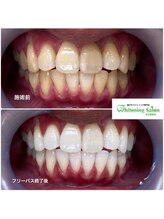ホワイトニングサロン 名古屋駅店/【ホワイトニング施術例】