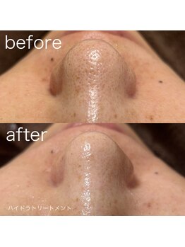 ルルラ リコ(lulula rico)/症例写真/ハイドラ毛穴洗浄