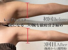 アンドエス 六本木(and S.)/レッドショットで二の腕すっきり