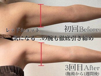 アンドエス 六本木(and S.)/レッドショットで二の腕すっきり