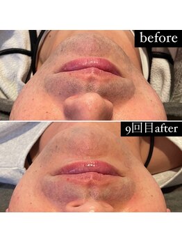 東京デトックス/【ビフォーアフター】ヒゲ脱毛