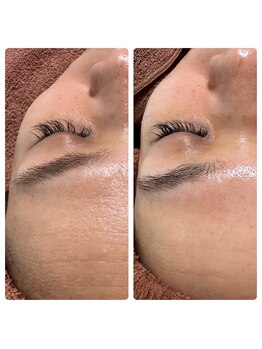 シャナ(Shana)/カーボキシー炭酸ガスパック