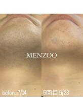 メンズー(MENZOO)/ヒゲ脱毛