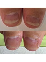 ウェルズユキ(well's yuki)/短い爪／爪を育てる／育成サロン