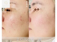 ウルワシ(Uruwashi)/ハーバルモアハーブピーリング