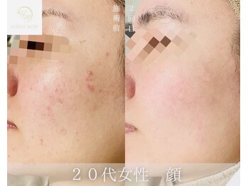 ウルワシ(Uruwashi)/ハーバルモアハーブピーリング