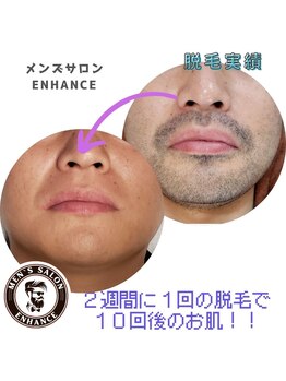 エンハンス 亀有(enhance)/脱毛実績