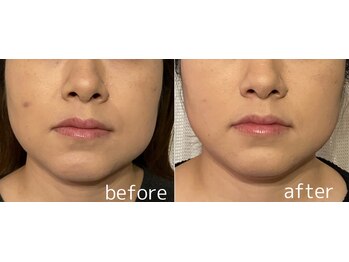 ララスマイル 鶴崎森町店/たるみ 頭痛 肩こり 巻き肩 整体