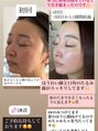 ミリュール(Millule)&nbsp;当店オリジナルマシンでの施術です。４回でリフトアップ小顔に