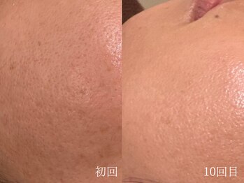 ウォーム(warm)/毛穴/毛穴洗浄/毛穴ケア/毛穴