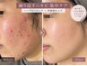 【繰り返すニキビに/ニキビ集中ケア】陶肌トリートメント+にきびOP+IPS幹細胞